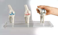 Erler Zimmer Knieimplantat